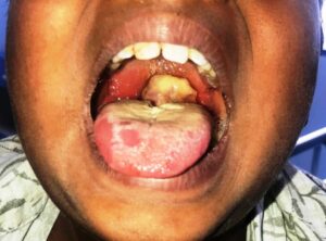 Diphtheria
